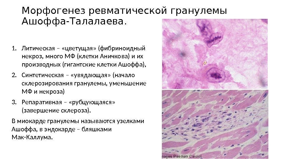 Морфогенез ревматической гранулемы Ашоффа-Талалаева. 1. Литическая – «цветущая» (фибриноидный некроз, много МФ (клетки Аничкова)