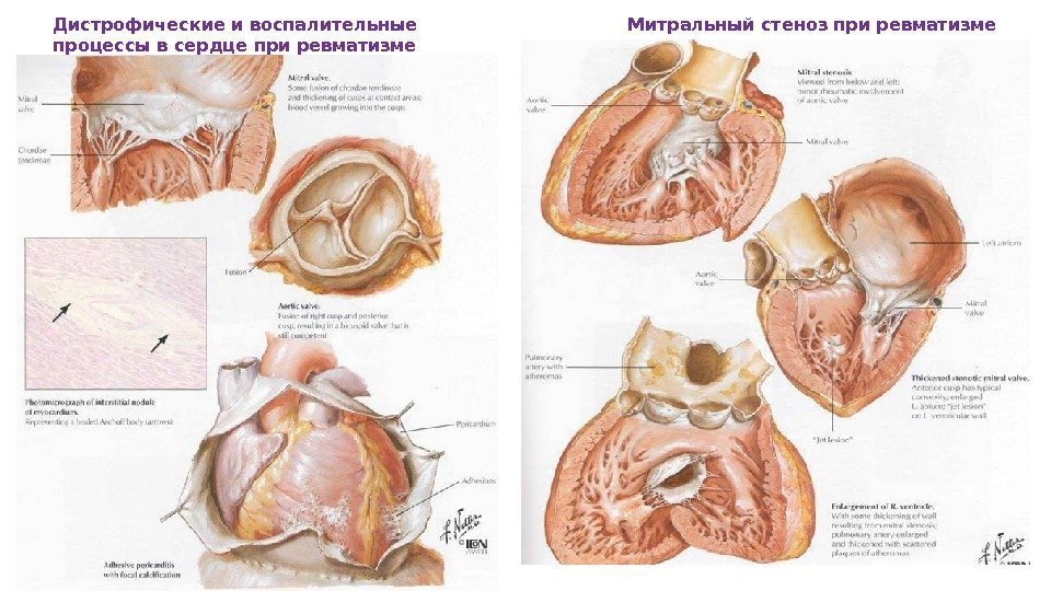 Дистрофические и воспалительные процессы в сердце при ревматизме Митральный стеноз при ревматизме 