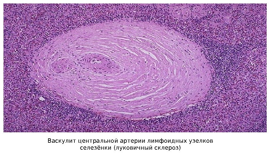 Васкулит центральной артерии лимфоидных узелков селезёнки (луковичный склероз) 