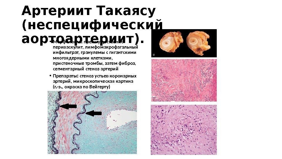 Артериит Такаясу (неспецифический аортоартериит).  • Морфология: преимущественно периваскулит, лимфомакрофагальный инфильтрат, гранулемы с гигантскими