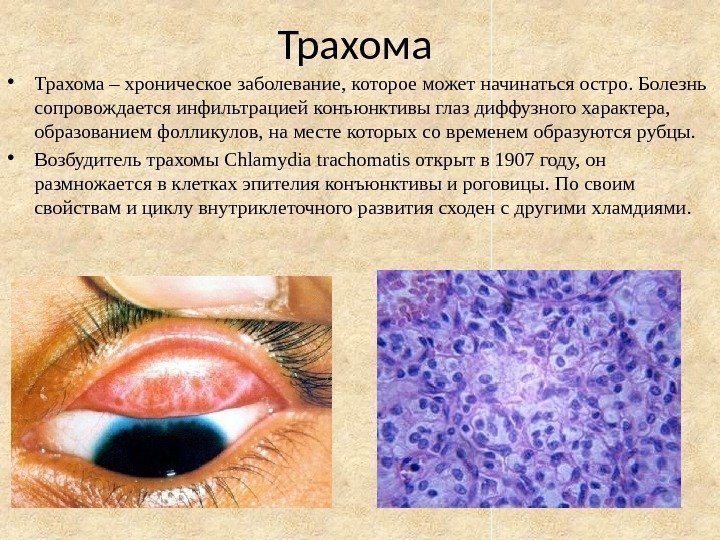 Трахома • Трахома – хроническое заболевание, которое может начинаться остро. Болезнь сопровождается инфильтрацией конъюнктивы