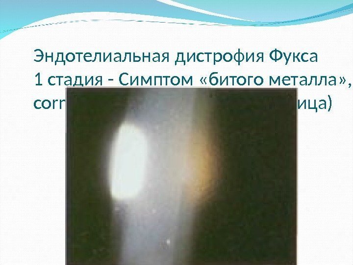 Эндотелиальная дистрофия Фукса 1 стадия - Симптом «битого металла» ,  cornea guttata (капельная