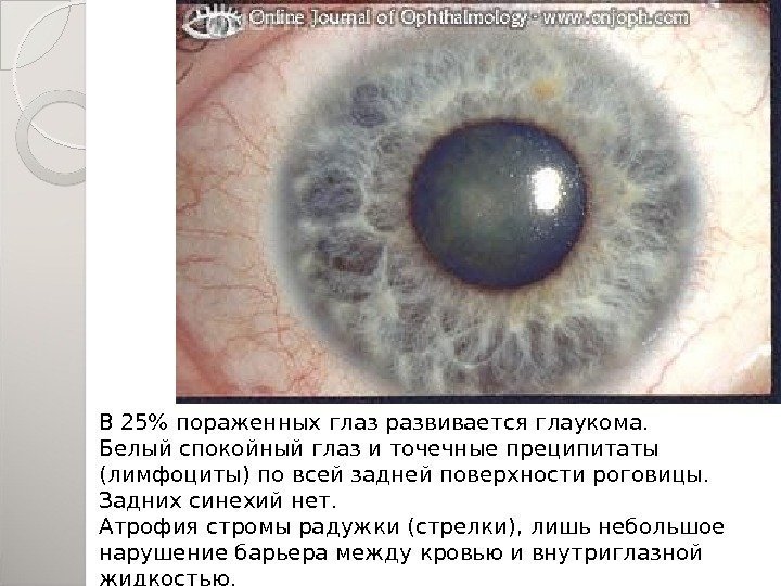 В 25 пораженных глаз развивается глаукома.  Белый спокойный глаз и точечные преципитаты (лимфоциты)