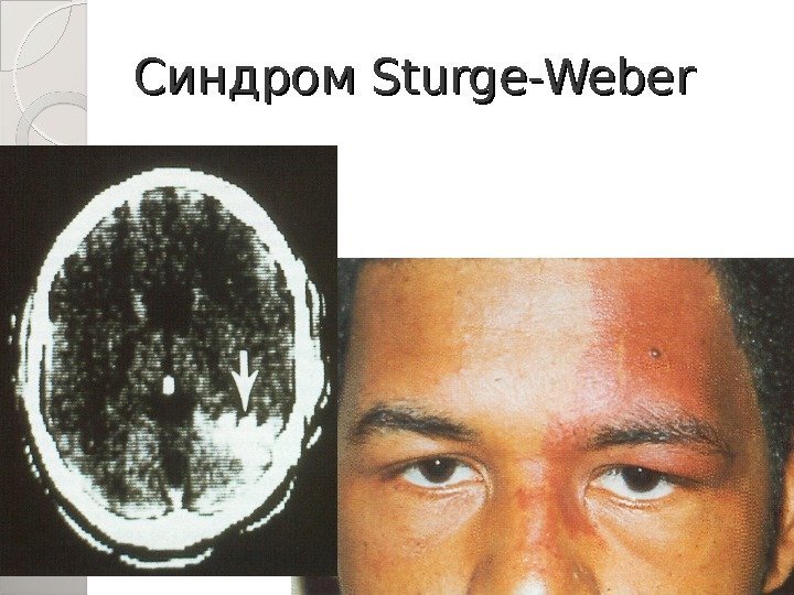 Синдром Sturge-Weber  