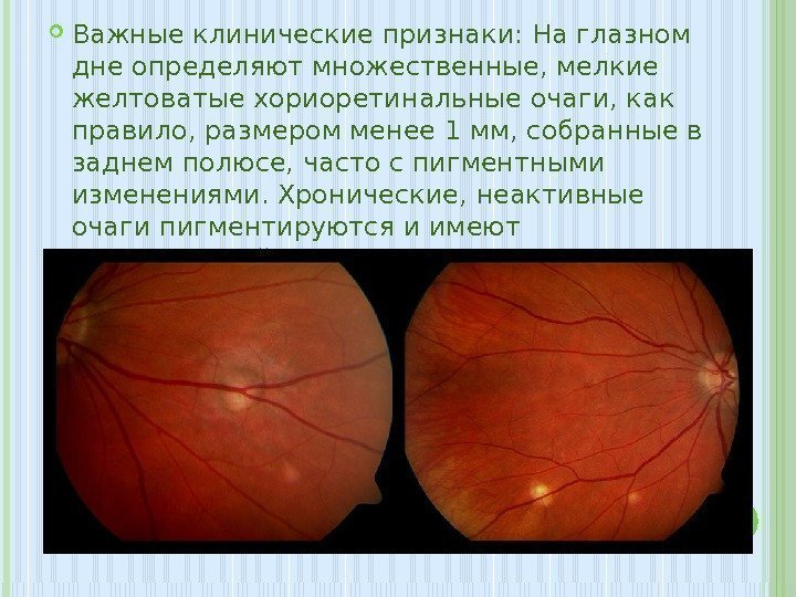  Важные клинические признаки: На глазном дне определяют множественные, мелкие желтоватые хориоретинальные очаги, как