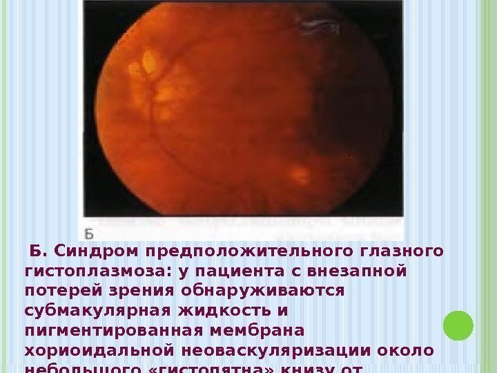  Б. Синдром предположительного глазного гистоплазмоза: у пациента с внезапной потерей зрения обнаруживаются субмакулярная