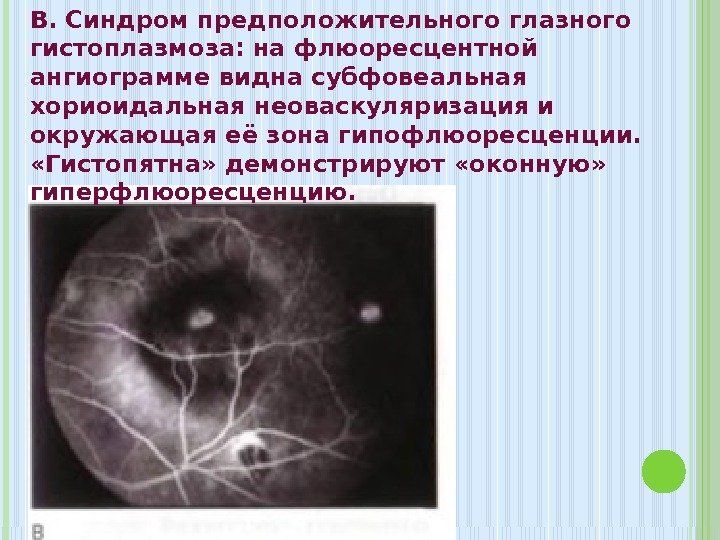 B. Синдром предположительного глазного гистоплазмоза: на флюоресцентной ангиограмме видна субфовеальная хориоидальная неоваскуляризация и окружающая