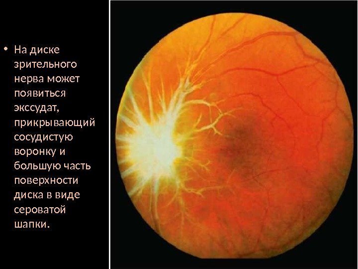  • На диске зрительного нерва может появиться экссудат,  прикрывающий сосудистую воронку и