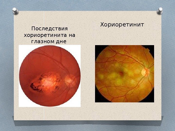 Последствия хориоретинита на глазном дне Хориоретинит  