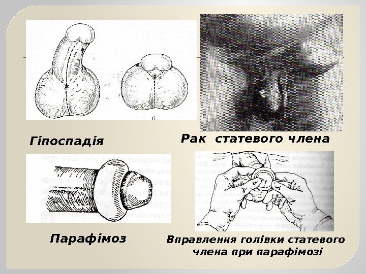Гіпоспадія Рак статевого члена Парафімоз Вправлення голівки статевого  члена при парафімозі  