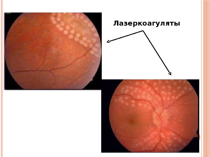 Лазеркоагуляты 