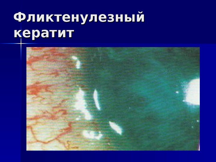 Фликтенулезный кератит 