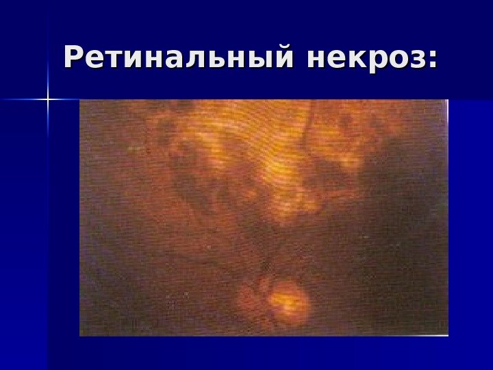 Ретинальный некроз: 