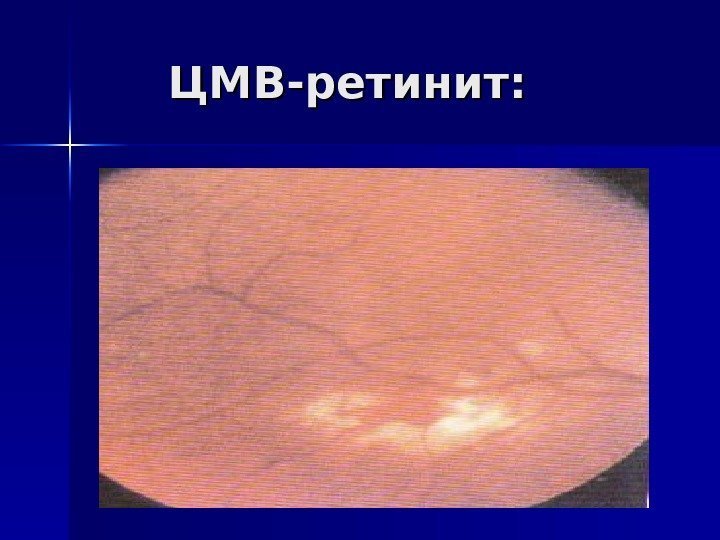   ЦМВ-ретинит: 