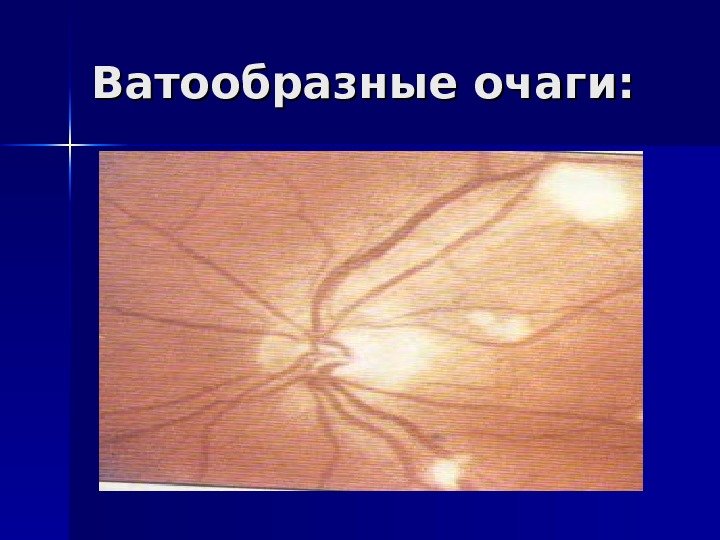 Ватообразные очаги: 