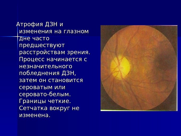  Атрофия ДЗН и изменения на глазном дне часто предшествуют расстройствам зрения.  Процесс