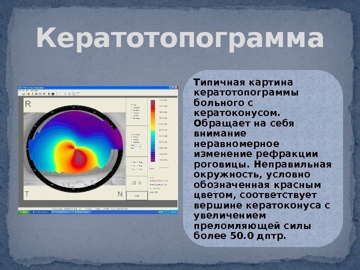 Картинки кератоконуса при оптической когерентной томографии