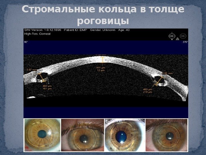 Стромальные кольца в толще роговицы 