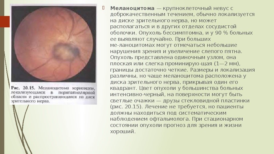  Меланоцитома — крупноклеточный невус с доброкачественным течением, обычно локализуется на диске зрительного нерва,