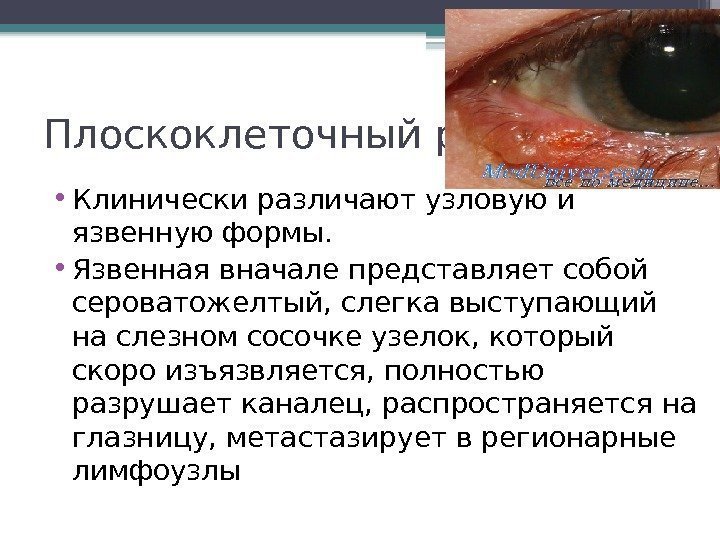 Плоскоклеточный рак • Клинически различают узловую и язвенную формы.  • Язвенная вначале представляет