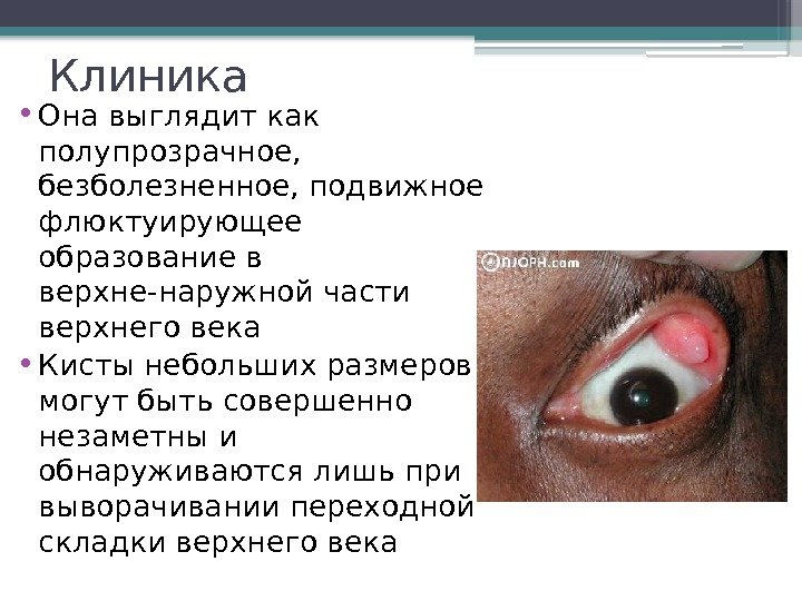 Клиника  • Она выглядит как полупрозрачное,  безболезненное, подвижное флюктуирующее образование в верхне-наружной