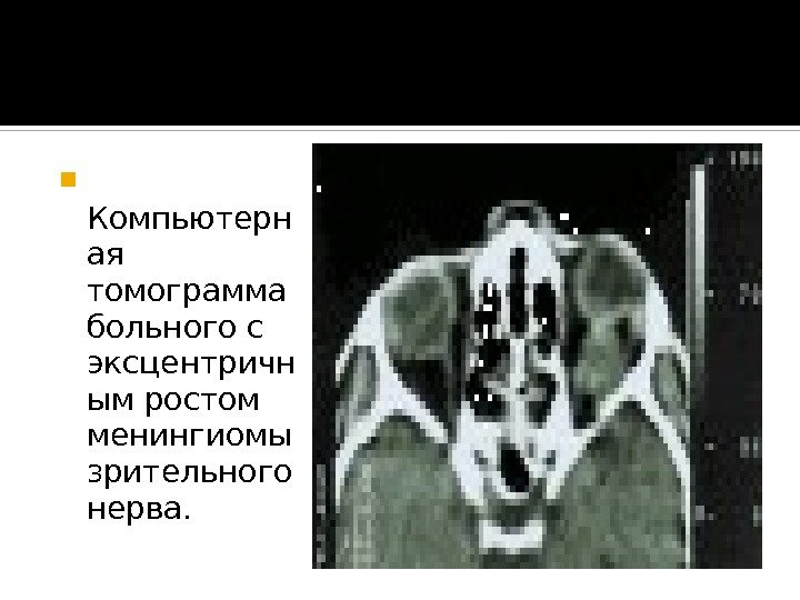   Компьютерн ая томограмма больного с эксцентричн ым ростом менингиомы зрительного нерва. 