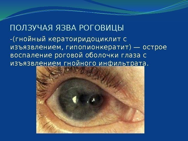 ПОЛЗУЧАЯ ЯЗВА РОГОВИЦЫ -(гнойный кератоиридоциклит с изъязвлением, гипопионкератит) — острое воспаление роговой оболочки глаза