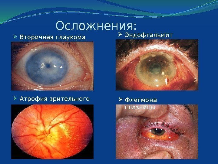    Осложнения:  Вторичная глаукома Атрофия зрительного нерва Эндофтальмит Флегмона глазницы 