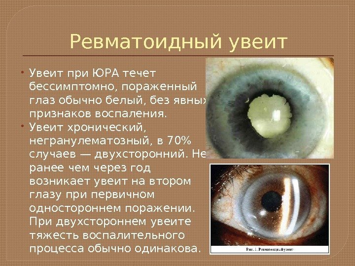 Ревматоидный увеит Увеит при ЮРА течет бессимптомно, пораженный глаз обычно белый, без явных признаков