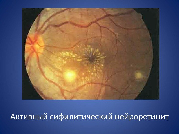 Активный сифилитический нейроретинит 