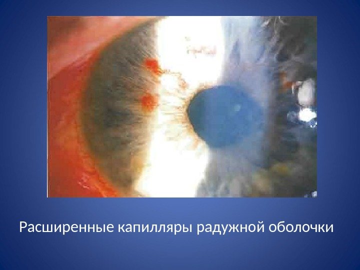 Расширенные капилляры радужной оболочки 