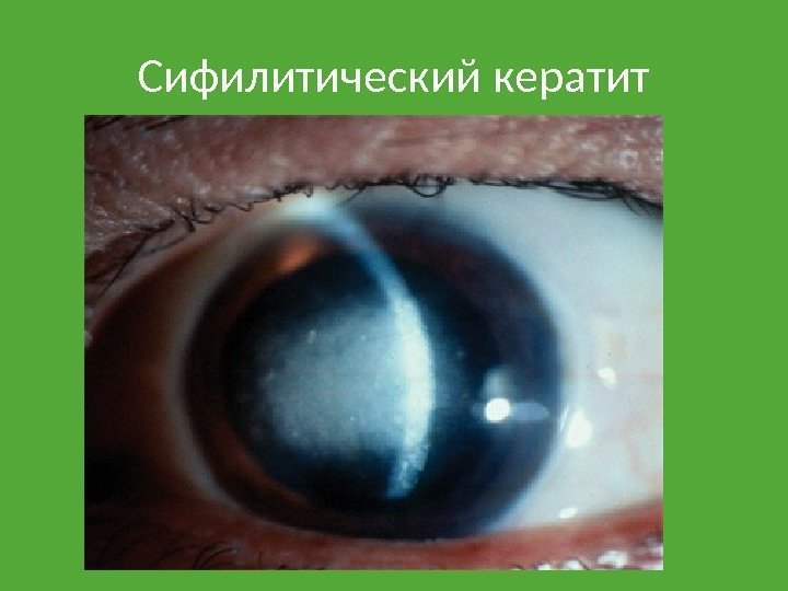 Сифилитический кератит 
