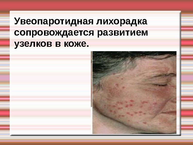 Увеопаротидная лихорадка сопровождается развитием узелков в коже.  