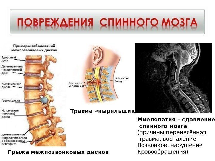 Травма «ныряльщика» Миелопатия – сдавление  спинного мозга (причины: перенесённая  травма, воспаление Позвонков,