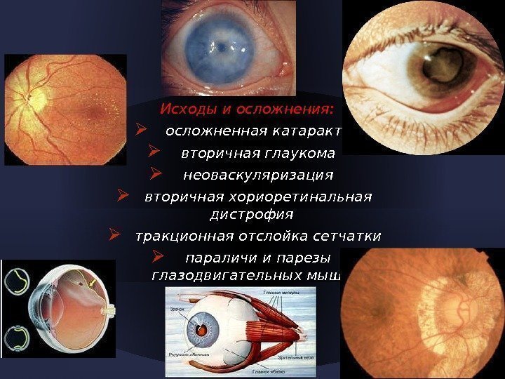 Исходы и осложнения: осложненная катаракта вторичная глаукома неоваскуляризация вторичная хориоретинальная дистрофия тракционная отслойка сетчатки