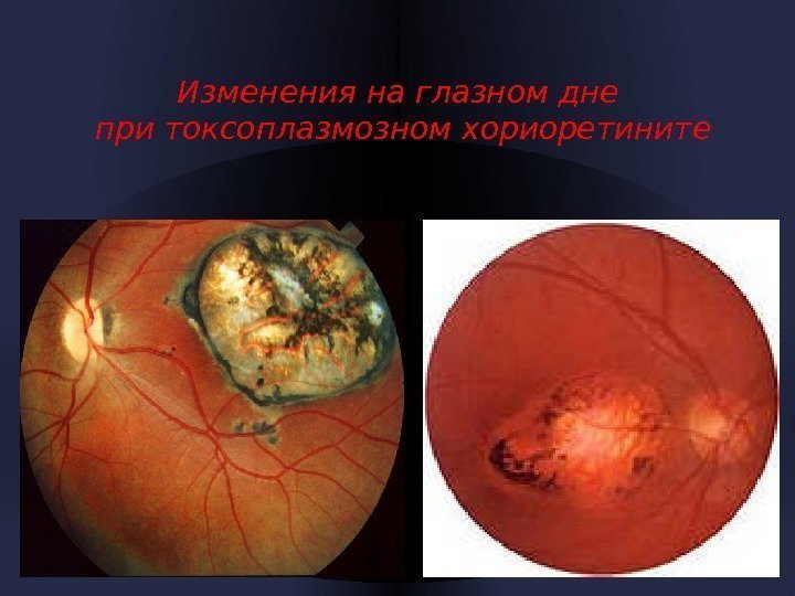 Изменения на глазном дне при токсоплазмозном хориоретините 