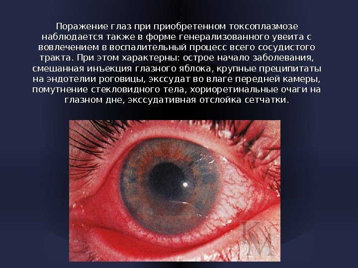 Поражение глаз приобретенном токсоплазмозе наблюдается также в форме генерализованного увеита с вовлечением в воспалительный