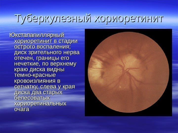   Туберкулезный хориоретинит  Юкстапапиллярный хориоретинит в стадии острого воспаления;  диск зрительного