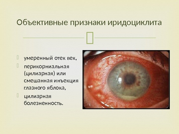 Объективные признаки иридоциклита умеренный отек век,  перикорниальная (цилиарная) или смешанная инъекция глазного яблока,