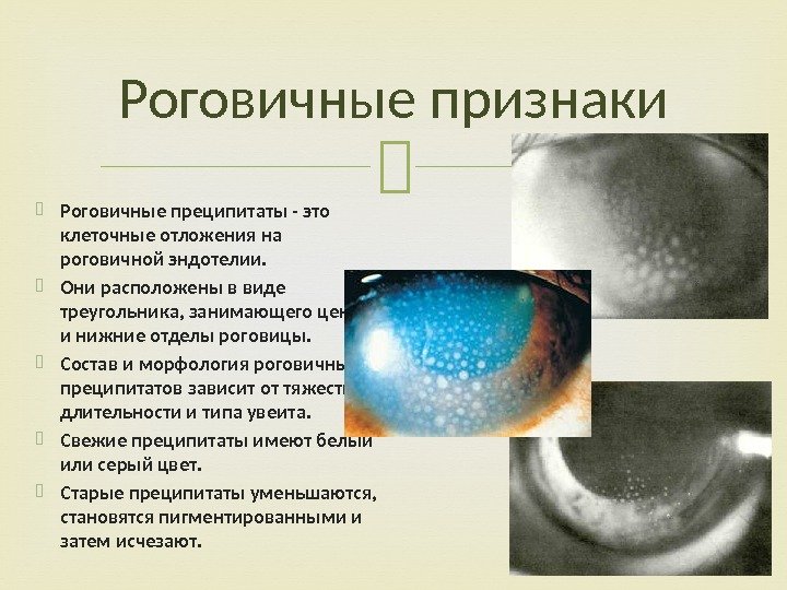 Роговичные признаки Роговичные преципитаты - это клеточные отложения на роговичной эндотелии.  Они расположены