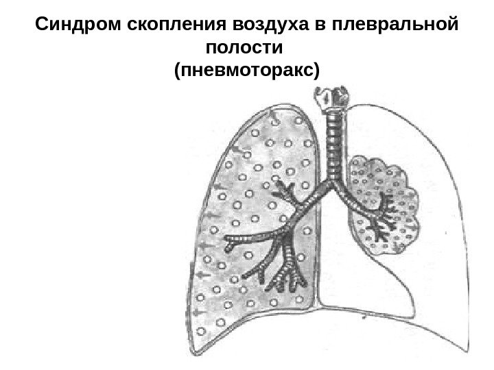   Синдром скопления воздуха в плевральной полости (пневмоторакс) 