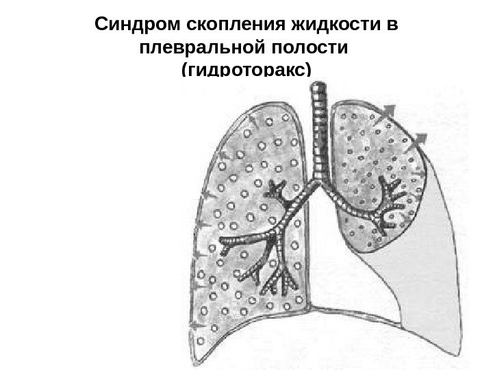   Синдром скопления жидкости в плевральной полости (гидроторакс) 