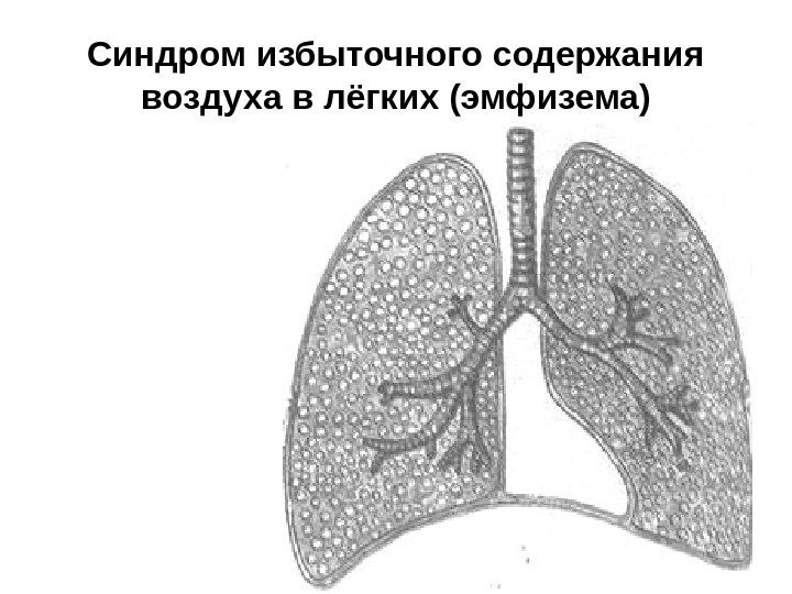   Синдром избыточного содержания воздуха в лёгких (эмфизема) 
