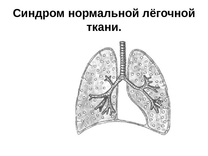   Синдром нормальной лёгочной ткани. 