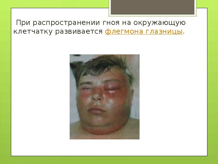  При распространении гноя на окружающую клетчатку развивается флегмона глазницы.    
