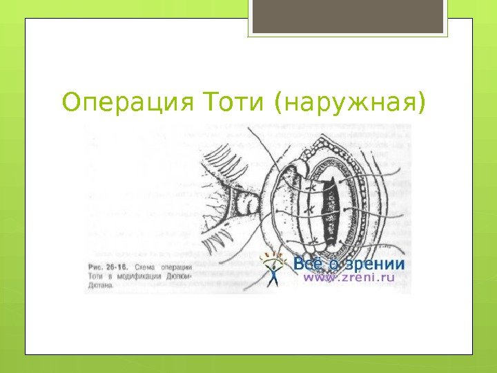Операция Тоти (наружная)     