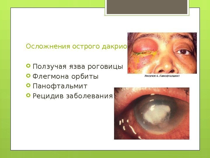 Осложнения острого дакриоцистита:  Ползучая язва роговицы Флегмона орбиты Панофтальмит Рецидив заболевания  