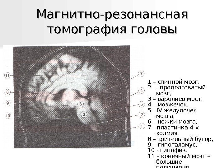   Магнитно-резонансная томография головы 1 – спинной мозг, 2 - продолговатый мозг, 3