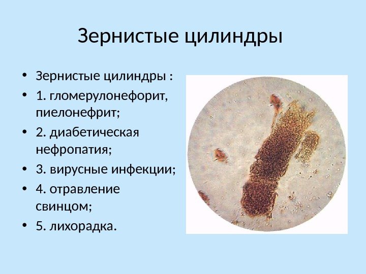 Зернистые цилиндры  • Зернистые цилиндры :  • 1. гломерулонефорит,  пиелонефрит; 