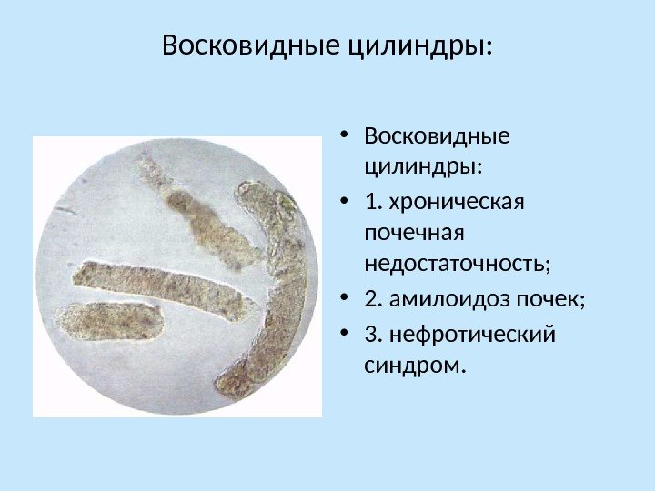 Восковидные цилиндры:  • 1. хроническая почечная недостаточность;  • 2. амилоидоз почек; 